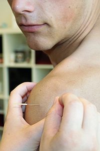 akupunktur i skulderen